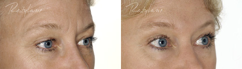 Restylane Before and After