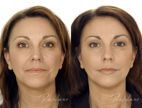 Restylane Before and After